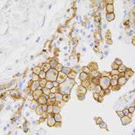 Melittin Induced G1 Cell Cycle Arrest and Apoptosis in Chago-K1 Human Bronchogenic Carcinoma Cells and Inhibited the Differentiation of THP-1 Cells into Tumour-Associated Macrophages